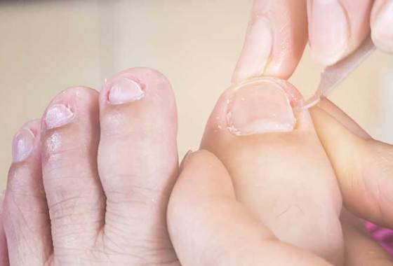 Best Ingrown Toenail Nippers